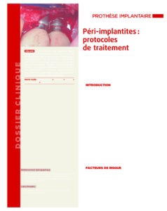 thumbnail of Peri-implantites protocoles de traitement