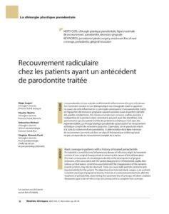 thumbnail of Recouvrement radiculaire chez des patients ayant des antecedents de maladies parodontales traitees.