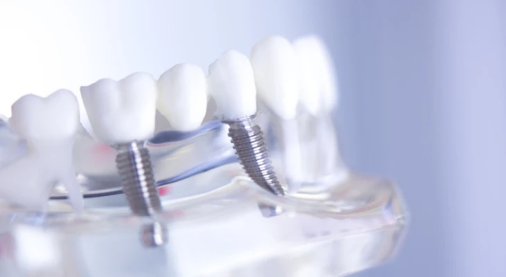 Extraction de dents incluses, Cabinet dentaire Massena