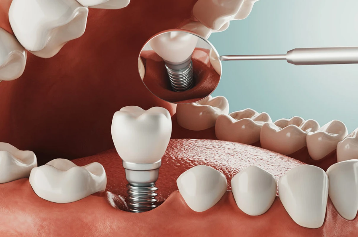 Implant dentaire unitaire